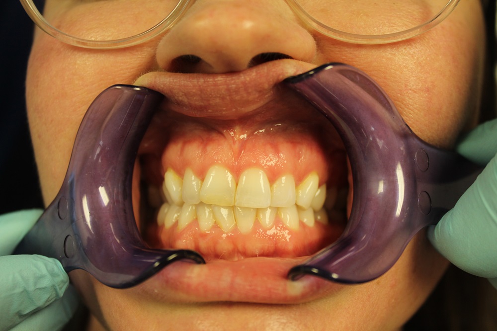 katie 12-14-20231 CLEAR ALIGNER BEFORE