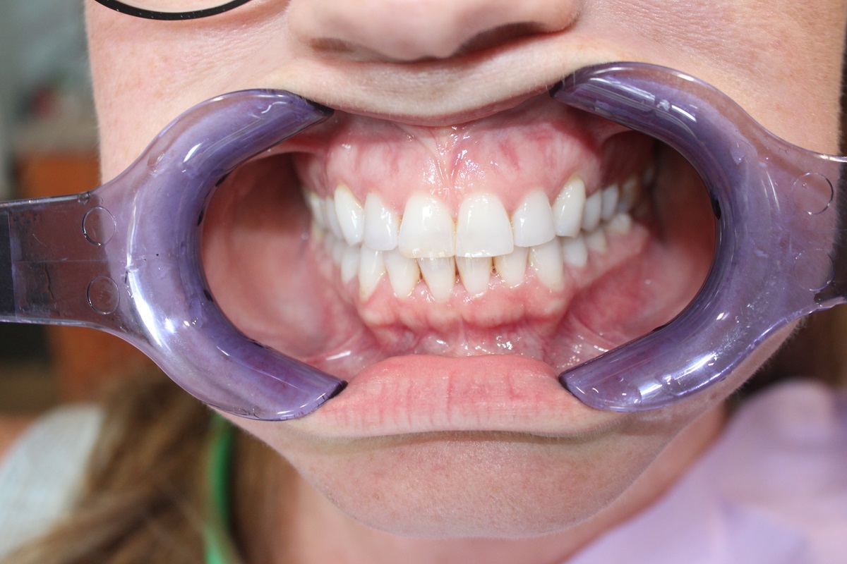 katie 8-13-20252 CLEAR ALIGNER AFTER